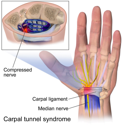 Carpal Tunnel and Workers' Compensation | MDASR, LLP